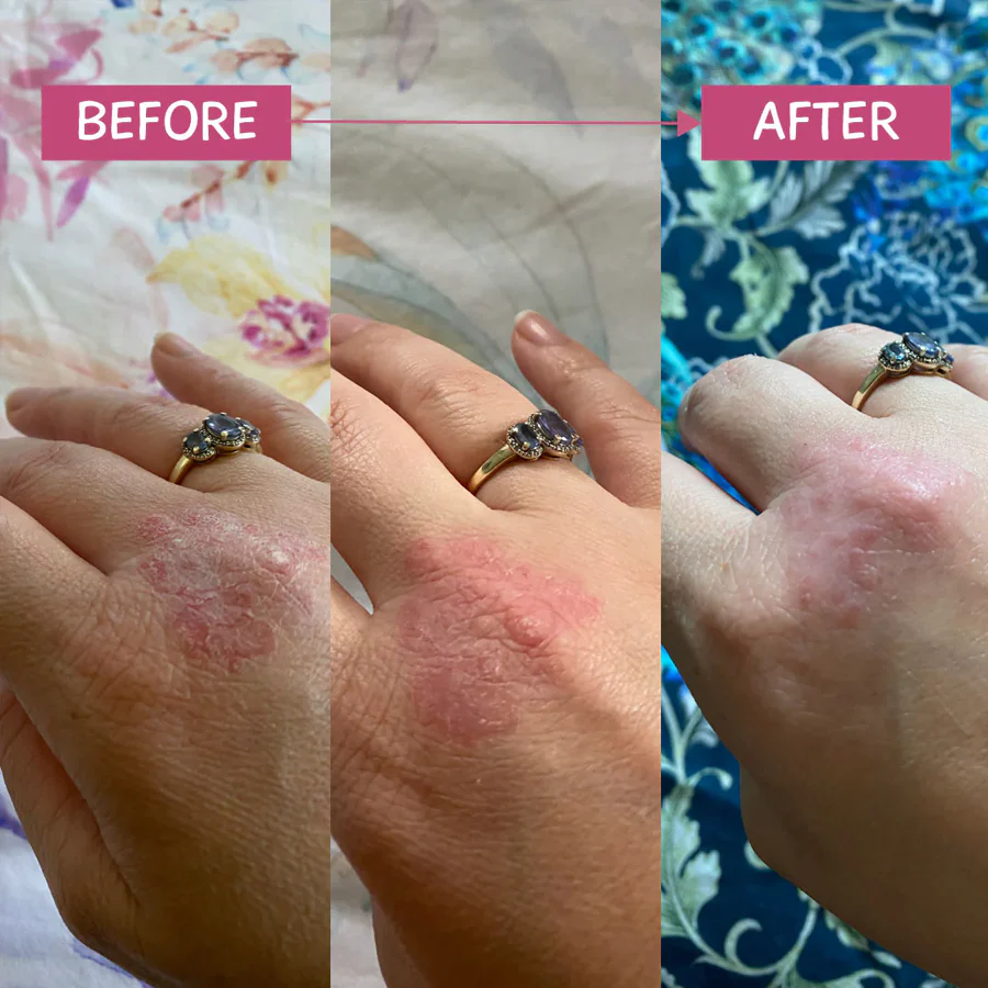 MooGoo Pink Eczema Cream 120g - Image 4